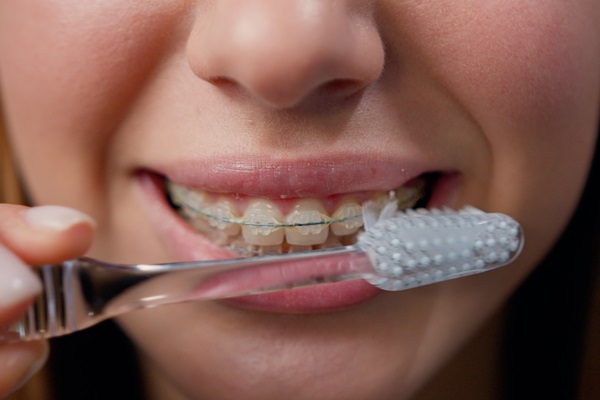 Things You May Not Have Known About Clear Braces